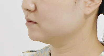 스몰핏 주사 전